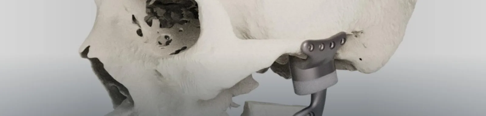 Skull with a temporomandibular joint prosthesis