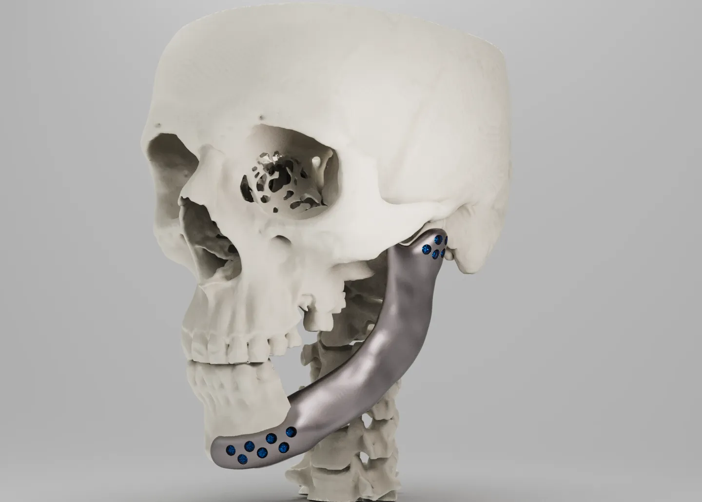 Custom titanium mandibular reconstruction, designed from the patient's own CT scan