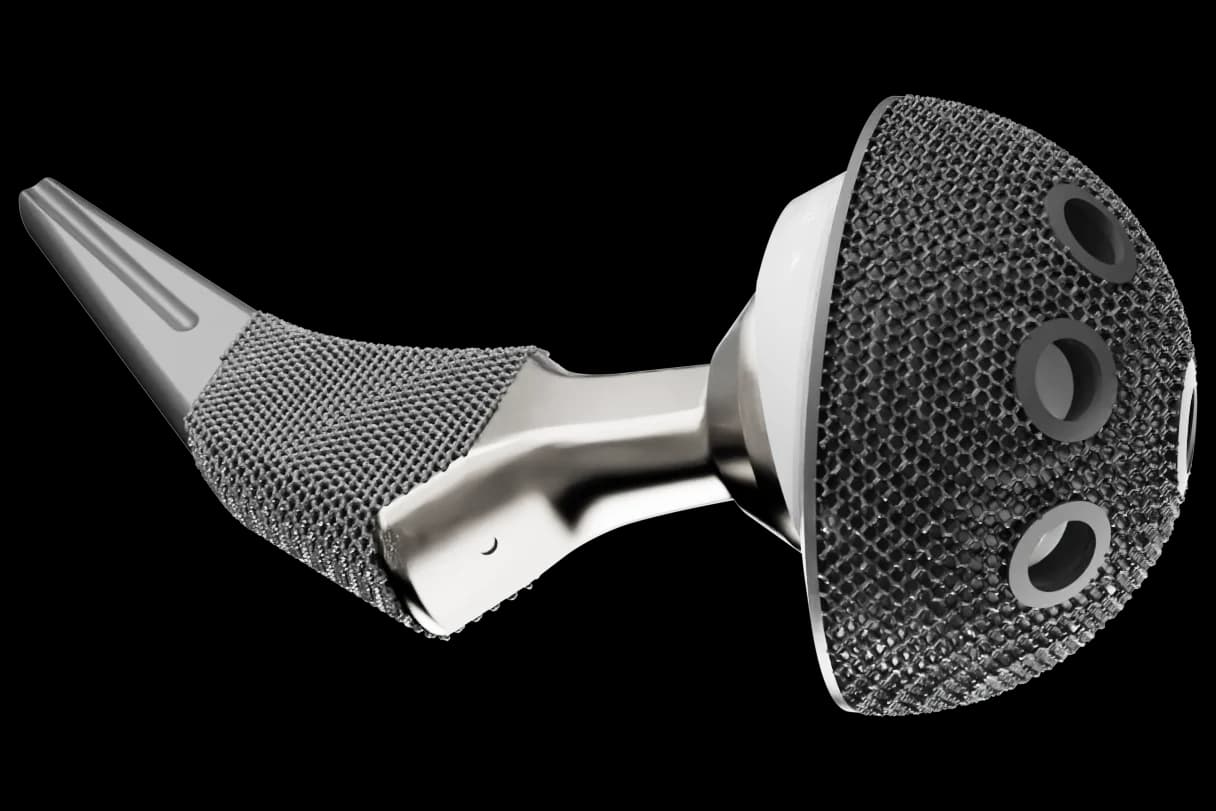 Trabecular titanium implant with a porous surface, made by 3D printing